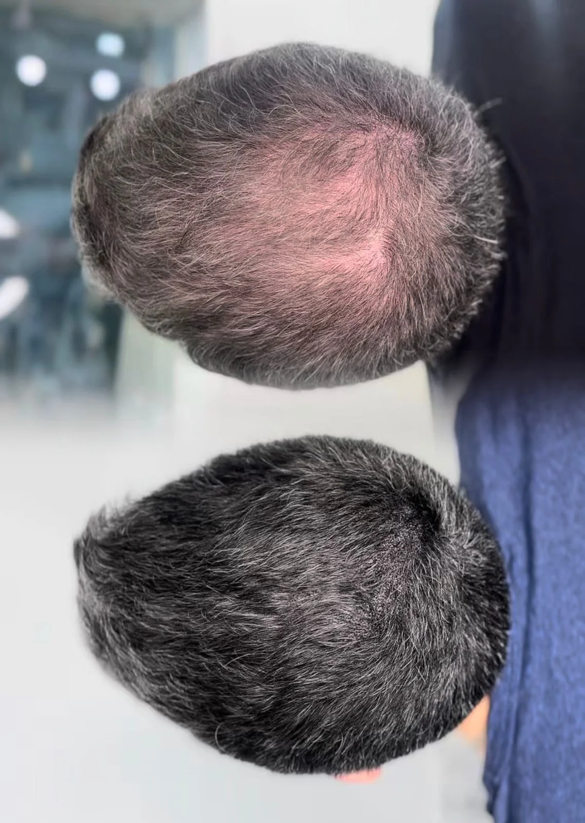 Antes y después micropigmentación capilar